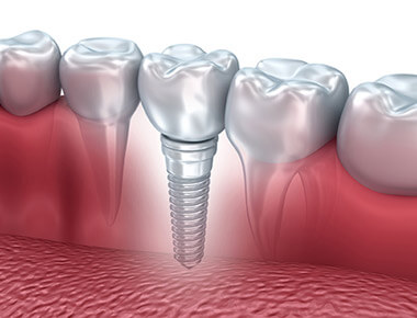 Dental implants are affordable