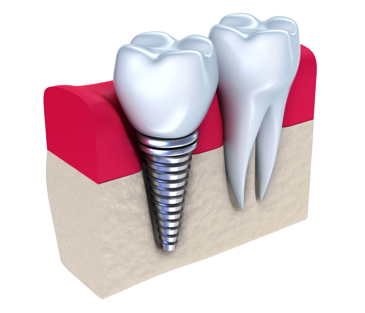 How dental bridges from your Bloomington, IL dentist differ from crowns