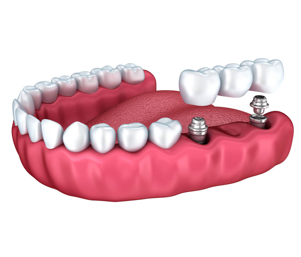 Get Perfect Dental Crowns in Bloomington IL