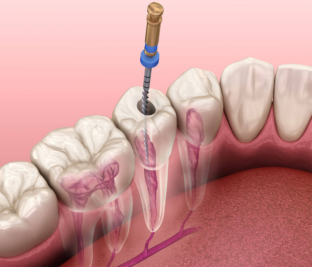 Restore your smile after root canal therapy with crown treatment in our Bloomington, IL office