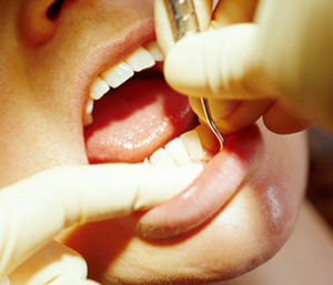 Gum Diseas Treatment