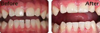 Cosmetic Bonding done for the actual patient, Bloomington
