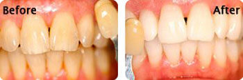 KOR Tooth Whitening done for the patient, Bloomington
