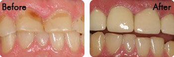 Porcelain Crowns & Composite Fillings real results, Bloomington