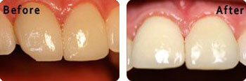 Chipped Tooth actual patient before and after, Bloomington