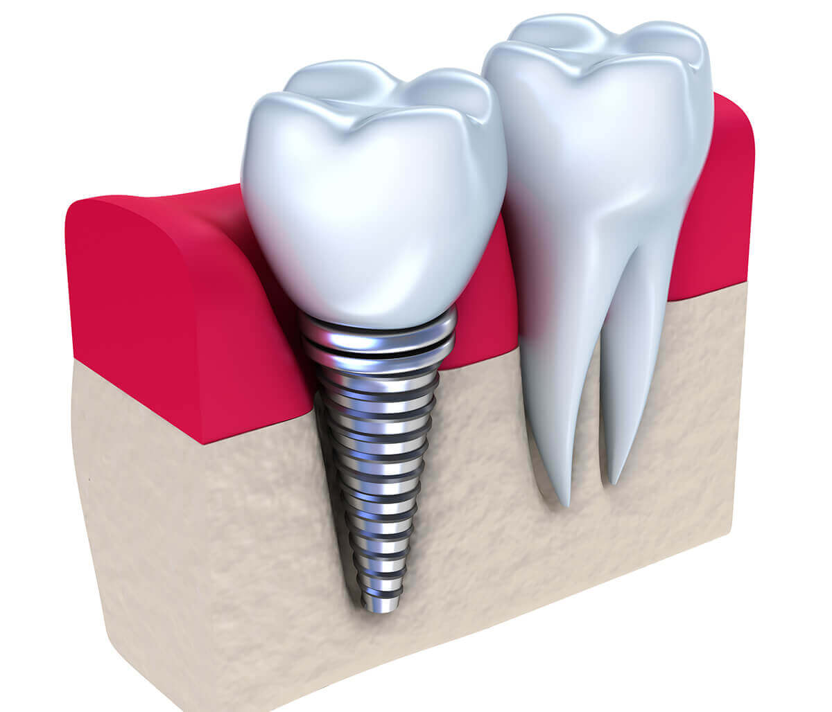 Implants Dentist Office at Eastland Dental Center located in Bloomington, IL Area