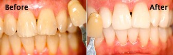 KOR Tooth Whitening real results, Bloomington