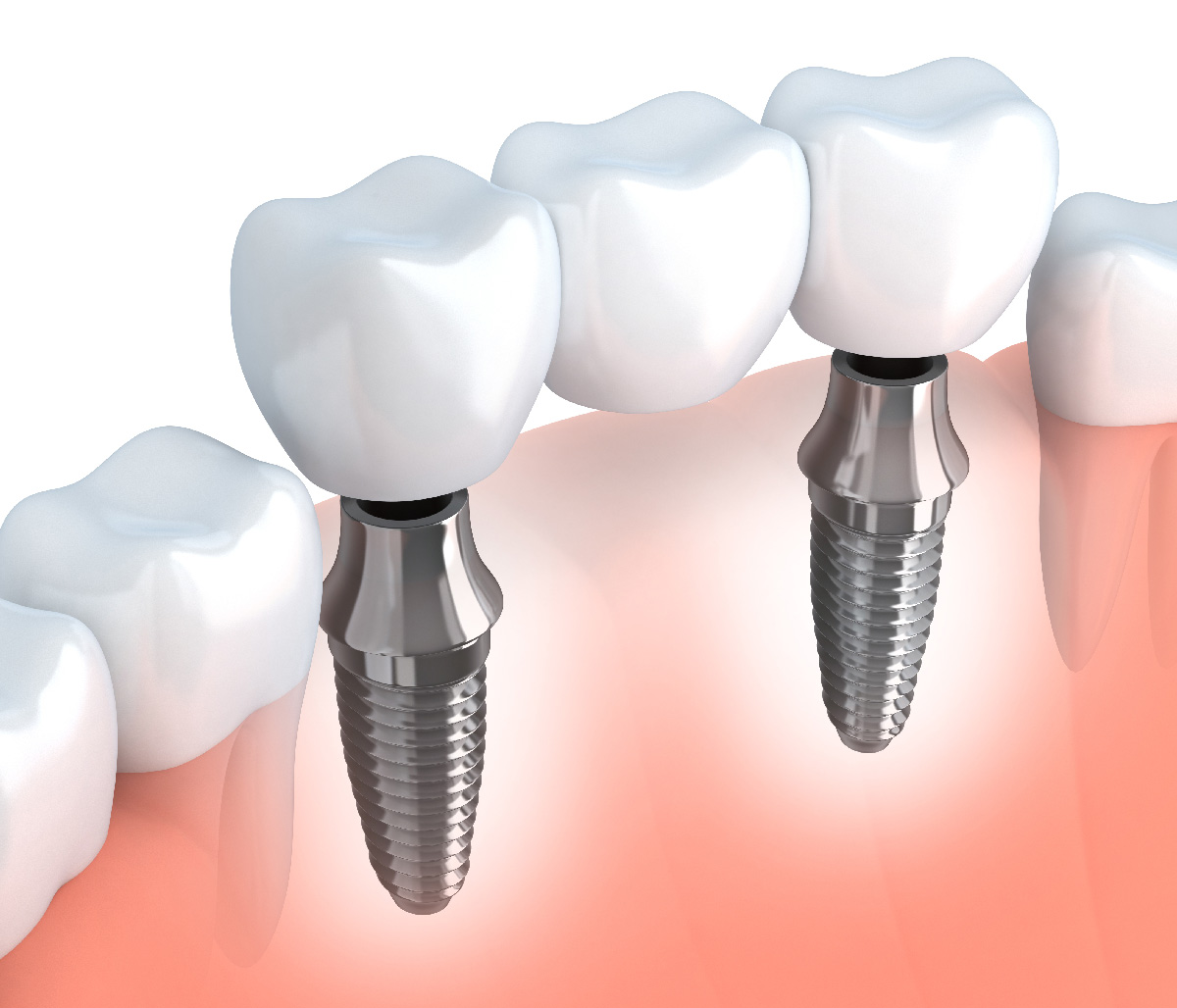 What Is The Single Tooth Implant Cost Near, Me In Bloomington