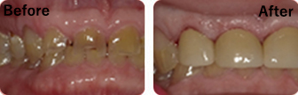 Patient Before And After Results - Crowns, Image-4, Eastland Dental Center, Bloomington