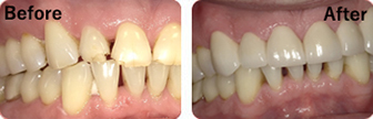 Patient Before And After Results - Crowns, Image-5, Eastland Dental Center, Bloomington