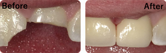 Patient Before And After Results - Crowns, Image-6, Eastland Dental Center, Bloomington