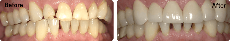 Patient Before And After Results - Crowns, Image-5, Eastland Dental Center, Bloomington
