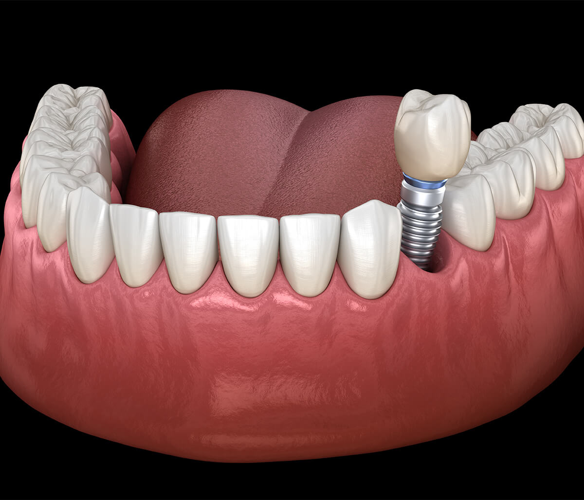Dental Implants for Back Teeth in Bloomington IL Area